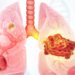 Conceptual 3D Illustration of Viral-Induced Lung Cancer