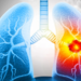 Medical Illustration showing lung cancer or bronchial carcinoma