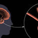 Tumor in the human brain