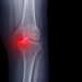 Film X-ray knee show degenerative osteoarthritis disease 