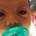 Infant with severe congenital glaucoma