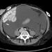 CT image showing large volume ascites and Leveen catheter tip