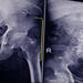 x-ray of hip joint