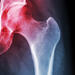 Inflamed hip joint