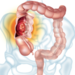 Illustration of cancer in the colon