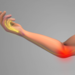 Illustration of nerve pain in the arm