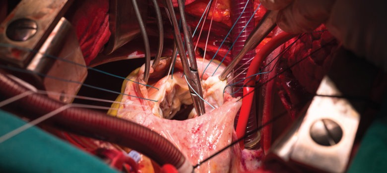 Repair tricuspid valve