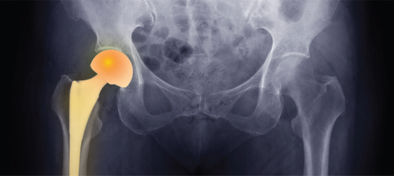 MRI of hip replacement