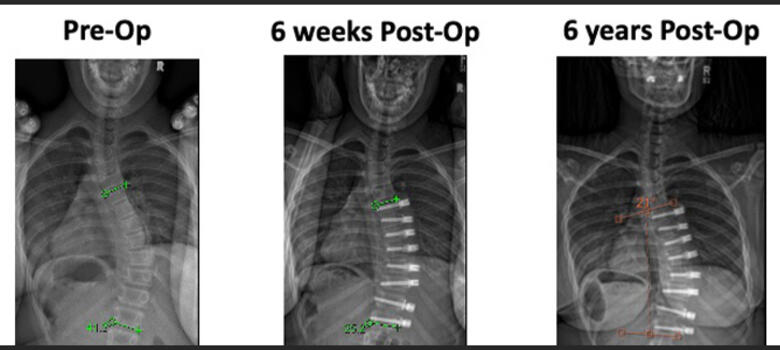 Xray of patient pre-op and post-op