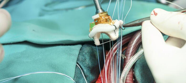 insertion of valve prothesis during surgery